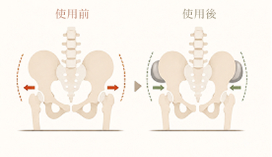 骨盤が開いている人の骨盤の図